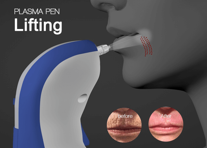 Plasma fine lines removal pen - News - 1