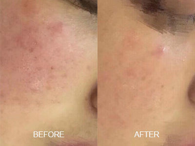 redness remove
