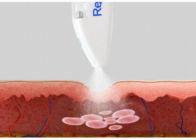 Jet mesogun working area and products