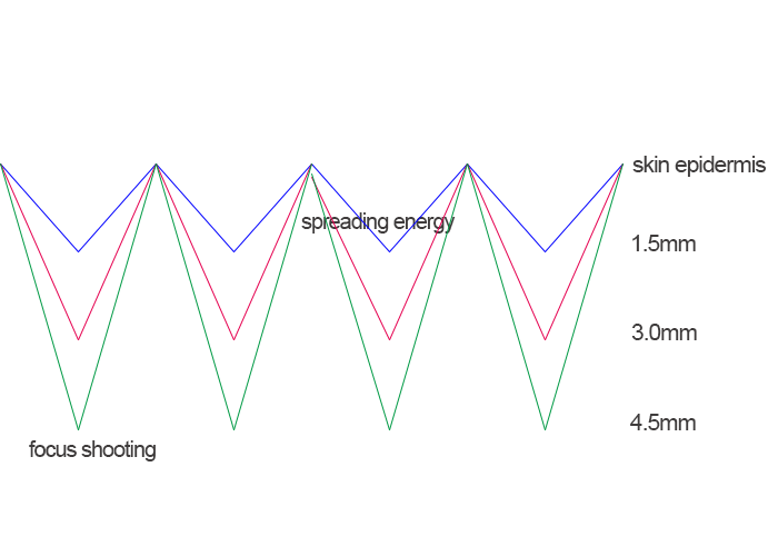 Does 9D HIFU machine effective? - News - 1