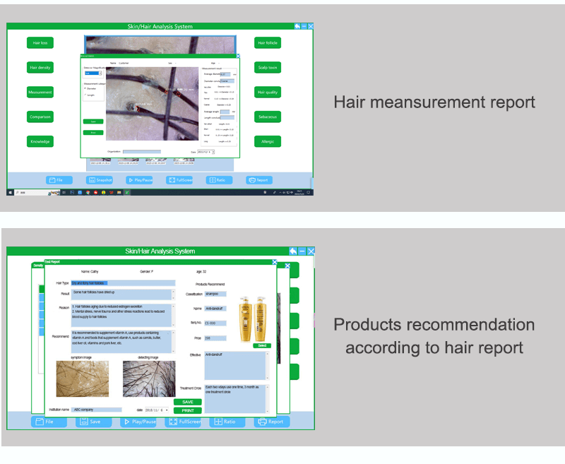 USB connection phone and computer connection hair scalp analysis -  - 8